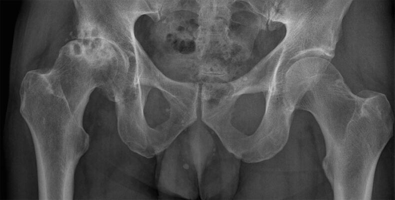 Марҳилаи 3 артрозҳои буғум дар рентген