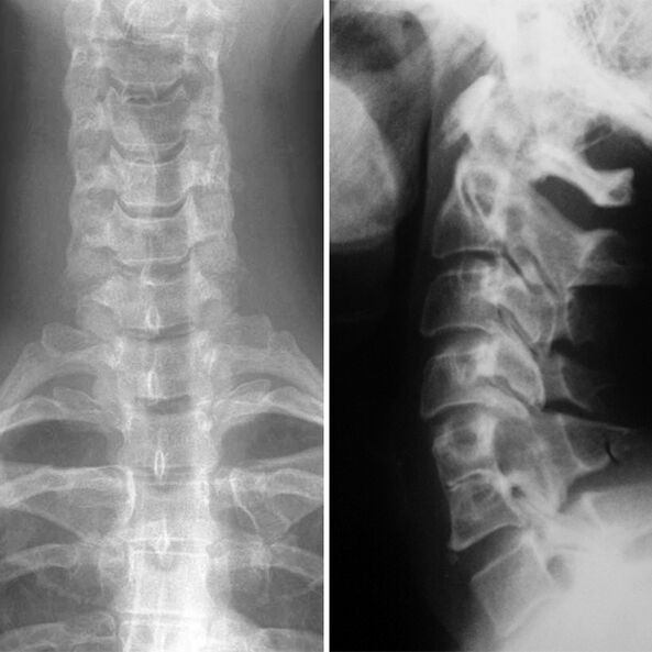 X -ray аз сутунмӯҳраам
