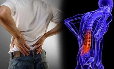 Сабабҳои рушди остеохондрозҳои Lumbar